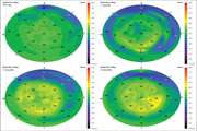 Evaluation of the effect of artificial tears on corneal epithelial thickness changes after photorefractive keratectomy