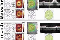 Retinal Ganglion Cell Loss Precedes Retinal Nerve Fiber Thinning in Nonarteritic Anterior Ischemic Optic Neuropathy