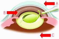 Endophthalmitis Occurring after Cataract Surgery: Outcomes of More Than 480 000 Cataract Surgeries, Epidemiologic Features, and Risk Factors