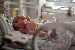 فراوانی رتینوپاتی نوزادان نارس و عوامل خطرساز آن در نوزادان نارس ارجاع شده به بیمارستان فارابی تهران