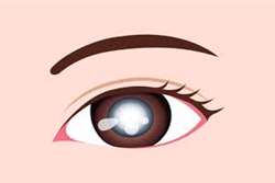 علل ایجاد آب مروارید و راه های درمان آن