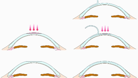 Changes in stereopsis after photorefractive keratectomy 