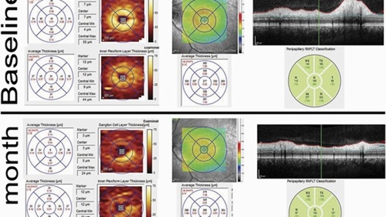 Retinal Ganglion Cell Loss Precedes Retinal Nerve Fiber Thinning in Nonarteritic Anterior Ischemic Optic Neuropathy 