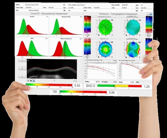 Corneal Biomechanical Findings in Contact Lens Induced Corneal Warpage 