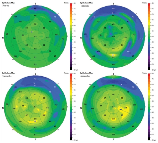 Evaluation of the effect of artificial tears on corneal epithelial thickness changes after photorefractive keratectomy 