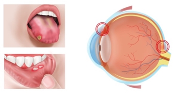 بیماری بهجت؛ وقتی التهاب، چشم‌ها را نشانه می‌گیرد